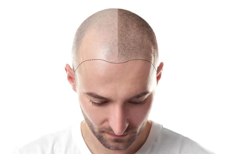 Micropigmentation Capillaire
