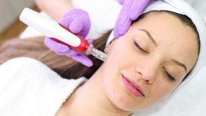 microneedling treatment