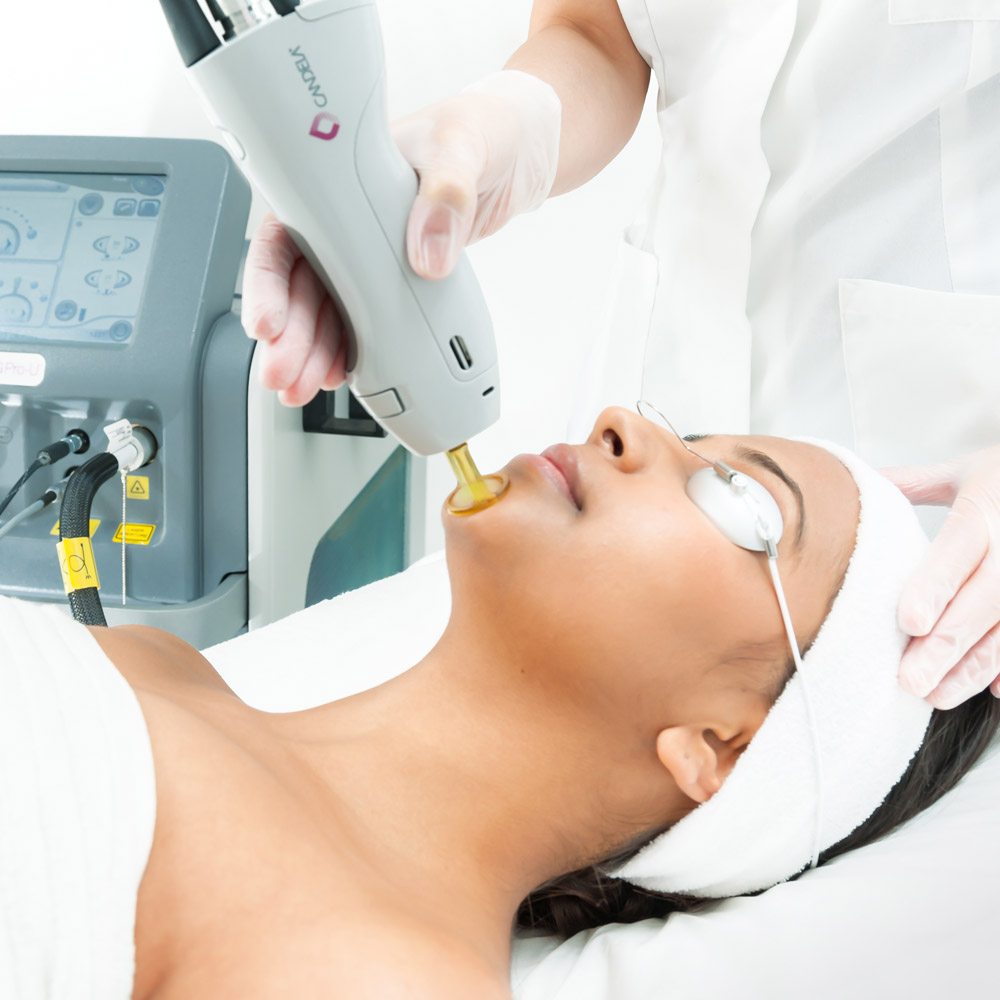 photorejuvenation treatment